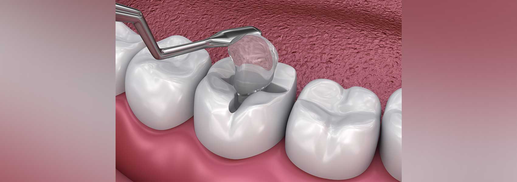 Dental fillings