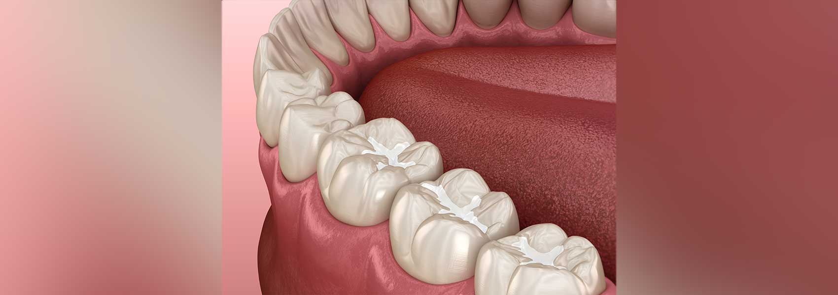 Dental sealants