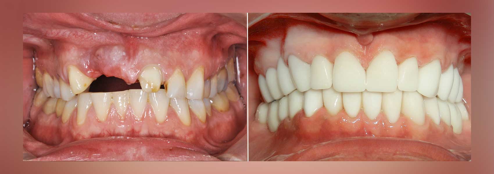 Full mouth restoration