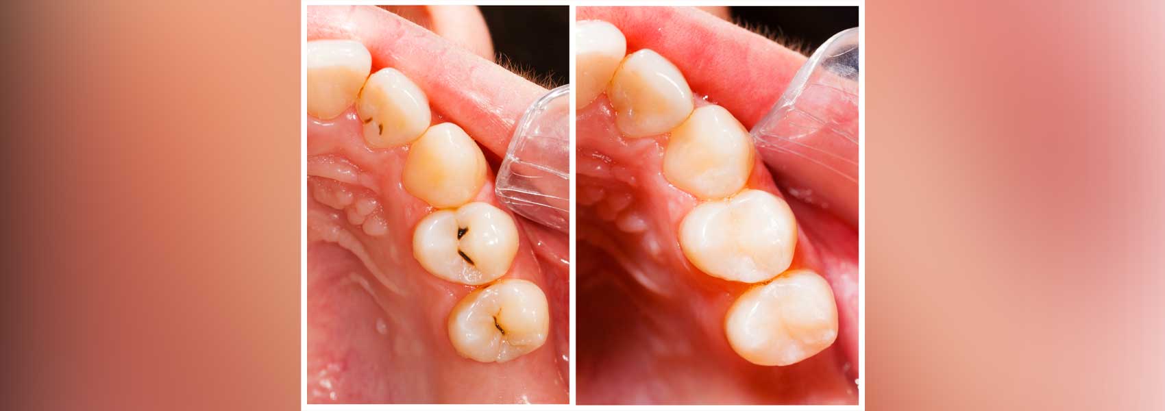 Tooth color filling