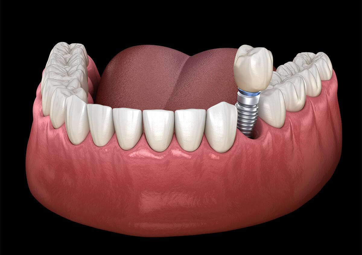 Implants Dentist Near Me Perry UT Area